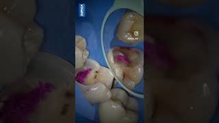 Caries removal with pulp exposuredentistry [upl. by Esimaj222]