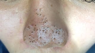 Big Cystic Acne Blackheads Extraction Blackheads amp Milia Whiteheads Removal Pimple Popping  2533 [upl. by Lai495]