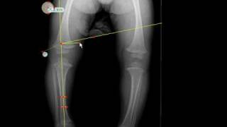 TraumaCad  MetaphysealDiaphyseal Angle [upl. by Katharina]