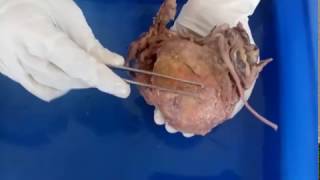 Urinary bladderAnatomyDissection videomalayalam [upl. by Ecneralc366]