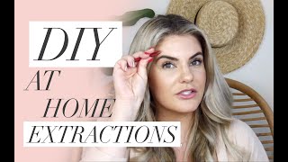 At Home Facial Extractions  Easy DIY [upl. by Ellevehc]