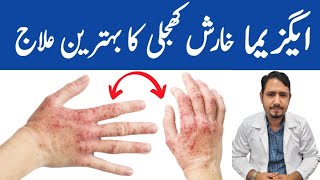 Magical Remedy For Eczema  Irfan Azeem [upl. by Eetnod]