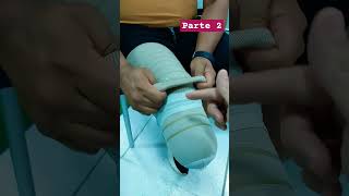 AmputeeOT How to take off and put on an Above Knee Prosthetic Leg [upl. by Ittocs]