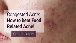 Congested Acne How to manage Food Related Acne [upl. by Ainorev]