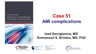 Case 51 PCI Manual  MI complications [upl. by Tristam]