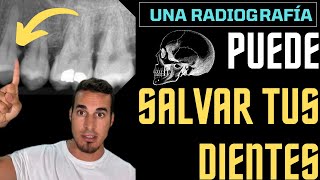 Una simple RADIOGRAFÍA podría SALVAR tus dientes 🛟  SARRO DENTAL [upl. by Chainey549]