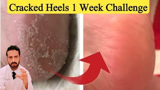 Cracked Heels 1 Week Solution  Quick Cracked Heel Treatment [upl. by Sinnek483]