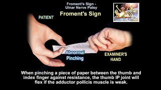 Froments Sign  Everything You Need To Know  Dr Nabil Ebraheim [upl. by Yendis207]