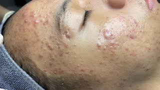 ACNE TREATMENT VU QUYNH MI  Blackheads Perennial EveryWhere Squeeze Nose 2024 [upl. by Flieger]