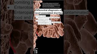 Differential diagnosis of travelassociated diarrhea [upl. by Fayre]