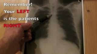 How to interpret a Chest Xray in under 4 minutes [upl. by Animahs]