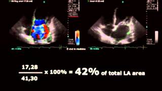 Volodymyr Pavliuk MD PhD Echocardiographic Assesment of Mitral Regurgitation [upl. by Michelle]