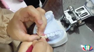 Dental Splinting Uncontinuous [upl. by Egap]