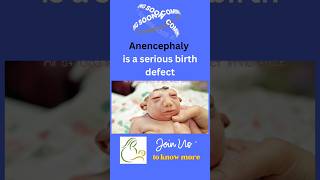 Anencephaly sonography  Dr Sudhanshu Tandon youtubeshorts 3dultrasound [upl. by Shear359]