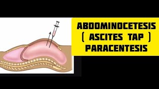 Ascites tap procedure  paracentesis  abdominocetesisn medics skills shorts [upl. by Dirraj519]