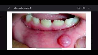 Mucocele oral  Patología oral [upl. by Angy]