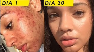 Esta chica cura su Acné en 30 días y TE CUENTA CÓMO  Eliminar Acné con productos naturales [upl. by Bonnice]