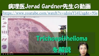 Trichoepitheliomaの病理組織像の解説 [upl. by Ylenats]