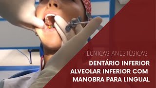 Técnica anestésica Dentário Inferior Alveolar Inferior com manobra para lingual [upl. by Akirehc]