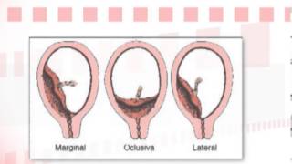 Dr Ignacio Pérez Tomasone ¿Qué es la placenta previa [upl. by Llimaj]