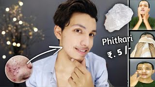 सिर्फ 3 दिन Use कर लो Acne Pimple Tiny Bumps खत्म  Phitkari  How To Use  100 Guranteed Results [upl. by Ambler]