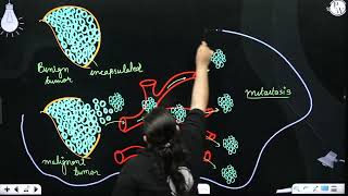Metastasis occurs in caseof [upl. by Odrick]
