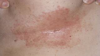 DermTV  How to Treat Under Breast Rashes amp Infections DermTVcom Epi 190 [upl. by High846]