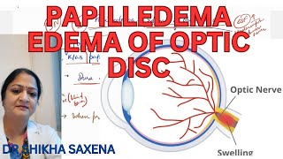 Papilliedema Edema of optic disc high CSF Pressure [upl. by Artemla]