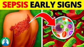 Top 10 Early Warning Signs of Sepsis  NEVER Ignore THIS [upl. by Paviour]