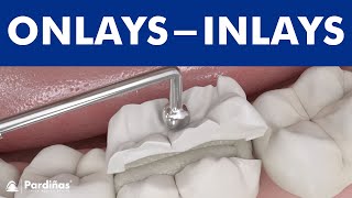 Dental inlays and onlays © [upl. by Shevlo]