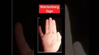 Wartenberg sign ytshorts neurology health [upl. by Eimiaj]