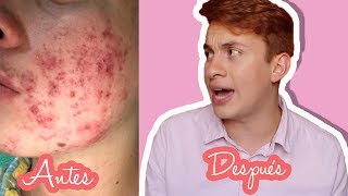 CÓMO ELIMINAR CICATRICES DE ACNE  Estas son las cremas que use  –Heeysoycesar [upl. by Amzaj]