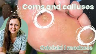 Corns and calluses  Odciski i modzele [upl. by Gurolinick]