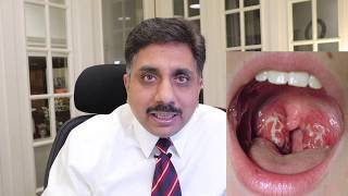 Homeopathic Medicines for Tonsillitis [upl. by Anaek]