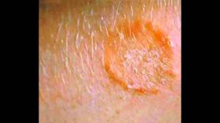 Skin Fungus Signs Symptoms Treatment HD [upl. by Neall550]