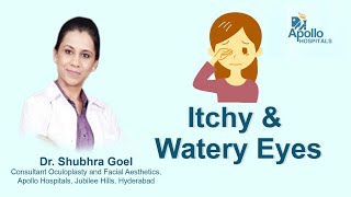 How to treat Itchy amp Watery Eyes  Dr Shubra Goel Consultant Oculoplastic amp Facial Aesthetics [upl. by Kevon]