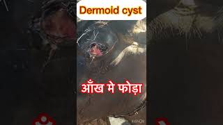 Dermoid cyst l Eye injection l dr Umar Khan [upl. by Menard]