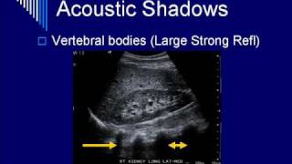 Physics of Ultrasound Image Artifacts Segment 5 [upl. by Rumney]