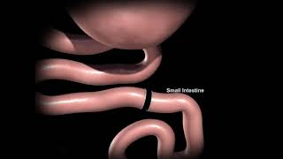 RouxenY Gastric Bypass Surgery  Dr Jayashree Todkar  Bariatric amp Obesity Surgeon [upl. by Raamal]