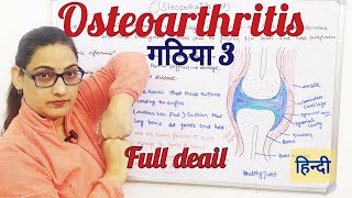 Osteoarthritis overview pathophysiology Cause SymptomsRisk Factors and Complications hindi [upl. by Felipa]