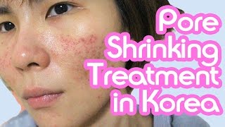 Shrinking my Pores in Korea Noninvasive skin treatment [upl. by Nahtaneoj]