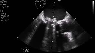 severe prosthetic mitral valve endocarditis with partial valve dehiscence [upl. by Harriman361]