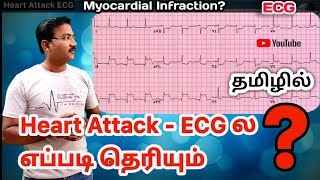 Heart attack ECG in tamil  MI myocardial infarction  anterior Inferior amp lateral wall MI ps tamil [upl. by Zingg]