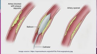 Understanding Peripheral Arterial Disease PAD [upl. by Iglesias882]