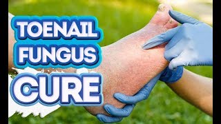 How to Cure Toenail Fungus Fast 3 BestEver Strategies [upl. by Melise]