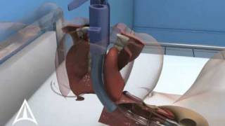 Intubix Endotracheal Tube Holder  3D Medical Device Animation [upl. by Yruam]