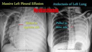 pleural effusion vs atelectasis [upl. by Gennie]