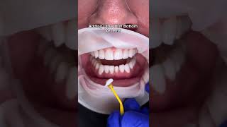 Adding ultra thin bottom veneers 🔍🦷👀 veneers ultrathin dentalveneers veneerteeth [upl. by Dickey]