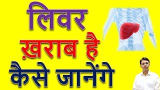 Liver Kharab Hone Ke Lakshan I Liver Damage Hone Ke Lakshan l Jondila Syrup Homeopathic [upl. by Nylyaj]