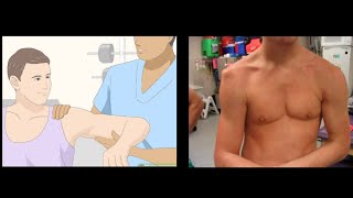 Shoulder Dislocation Reduction Technique  How to reduce Shoulder Dislocation [upl. by Derrej]